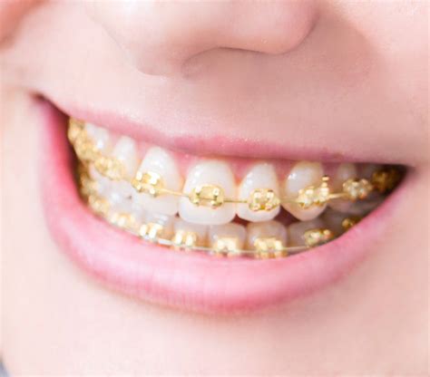 real gold braces